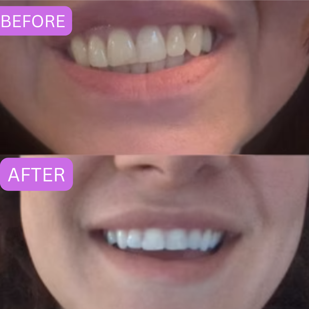 GlowKorean Purple Teeth Whitening Strips