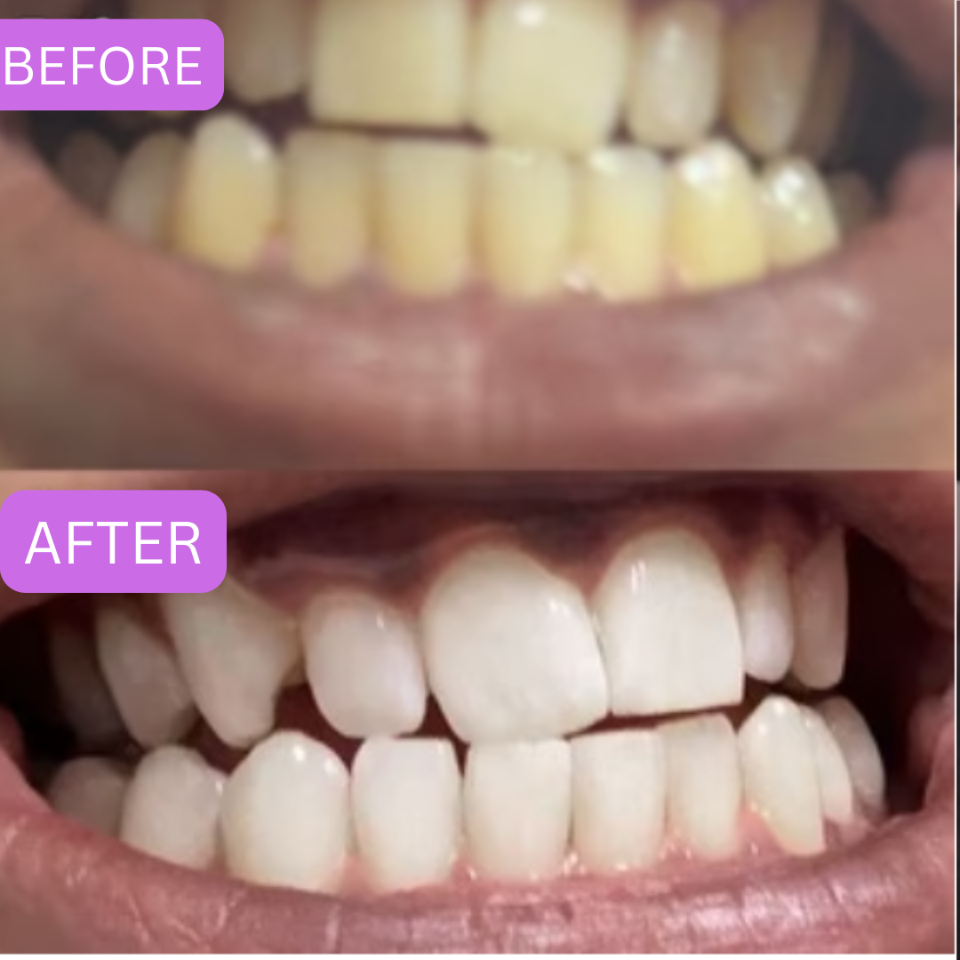 GlowKorean Purple Teeth Whitening Strips